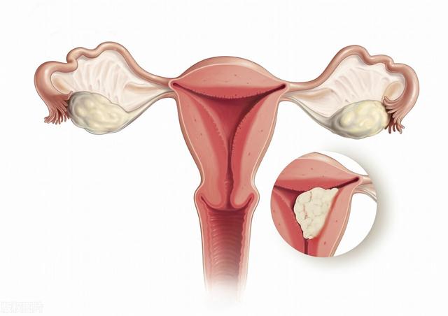 女性陰挺是怎么回事？對身體健康有影響嗎？需要治療嗎？