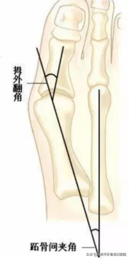 这些女明星的脚太吓人了!高跟鞋下,拇指外翻到底有多疼?
