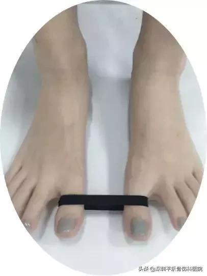 这些女明星的脚太吓人了!高跟鞋下,拇指外翻到底有多疼?