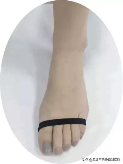 这些女明星的脚太吓人了!高跟鞋下,拇指外翻到底有多疼?