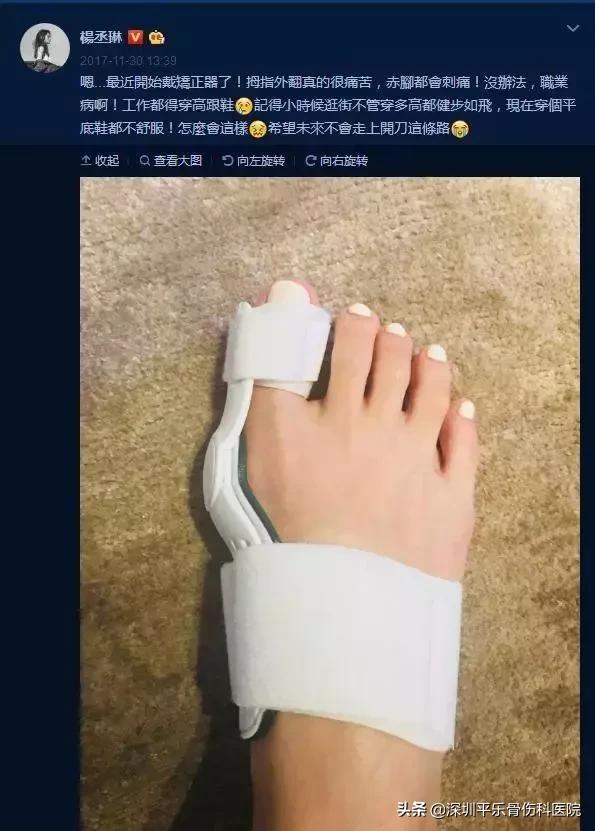这些女明星的脚太吓人了!高跟鞋下,拇指外翻到底有多疼?