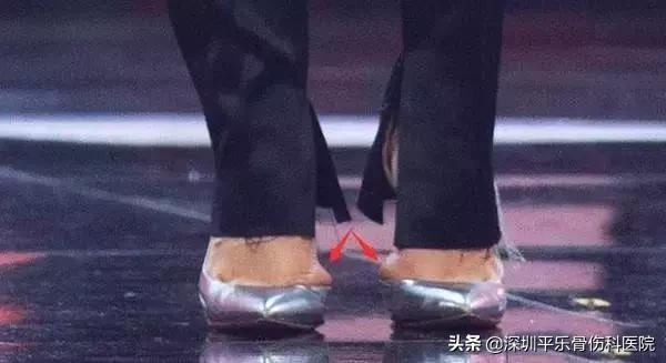 这些女明星的脚太吓人了!高跟鞋下,拇指外翻到底有多疼?