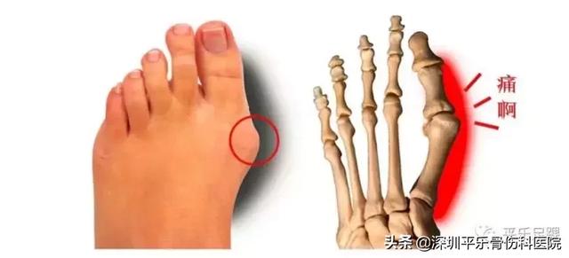 这些女明星的脚太吓人了!高跟鞋下,拇指外翻到底有多疼?