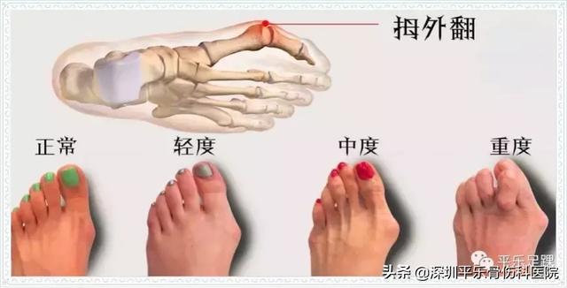 这些女明星的脚太吓人了!高跟鞋下,拇指外翻到底有多疼?