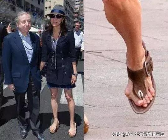 这些女明星的脚太吓人了!高跟鞋下,拇指外翻到底有多疼?