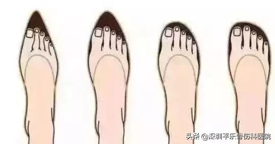 这些女明星的脚太吓人了!高跟鞋下,拇指外翻到底有多疼?