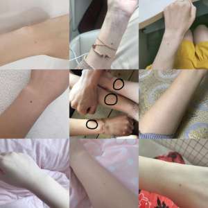 女人痣相圖解(很多人“手臂中間有顆痣”，其實(shí)是胎記痣，可能在胎兒期就已注定)