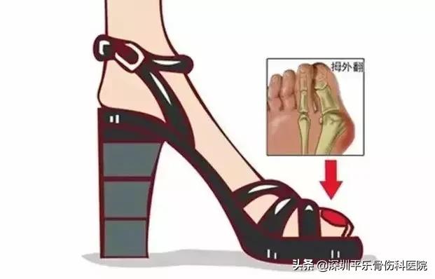 这些女明星的脚太吓人了!高跟鞋下,拇指外翻到底有多疼?