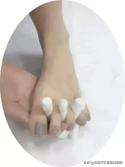 这些女明星的脚太吓人了!高跟鞋下,拇指外翻到底有多疼?